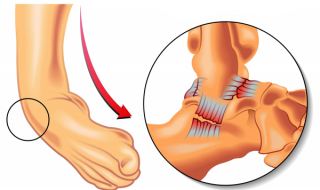 ankle-sprain1